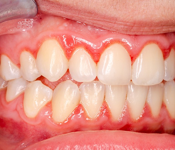 View of red and swollen gums