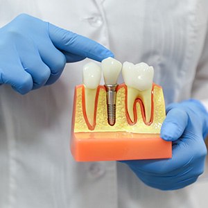 a model of dental implants