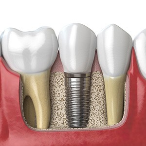 diagram of an implant that has integrated with bone